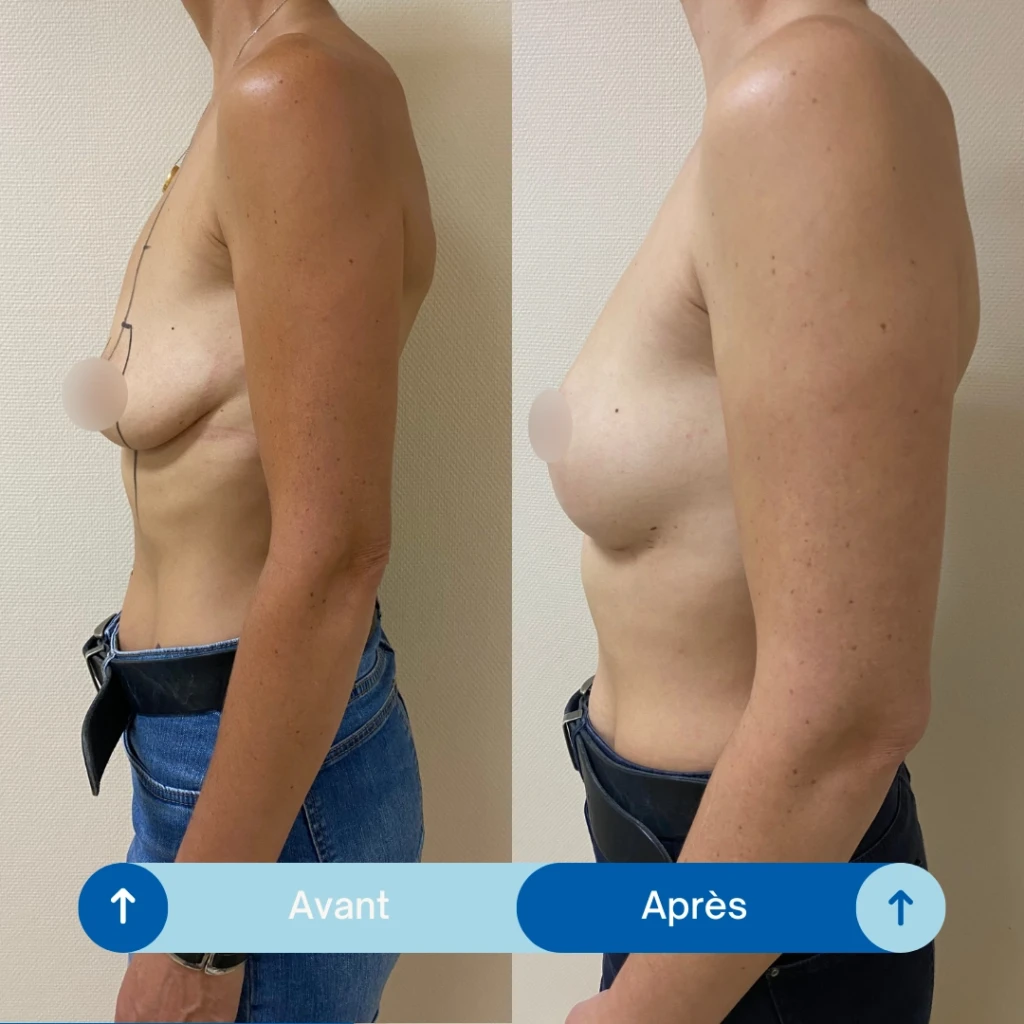 Augmentation mammaire