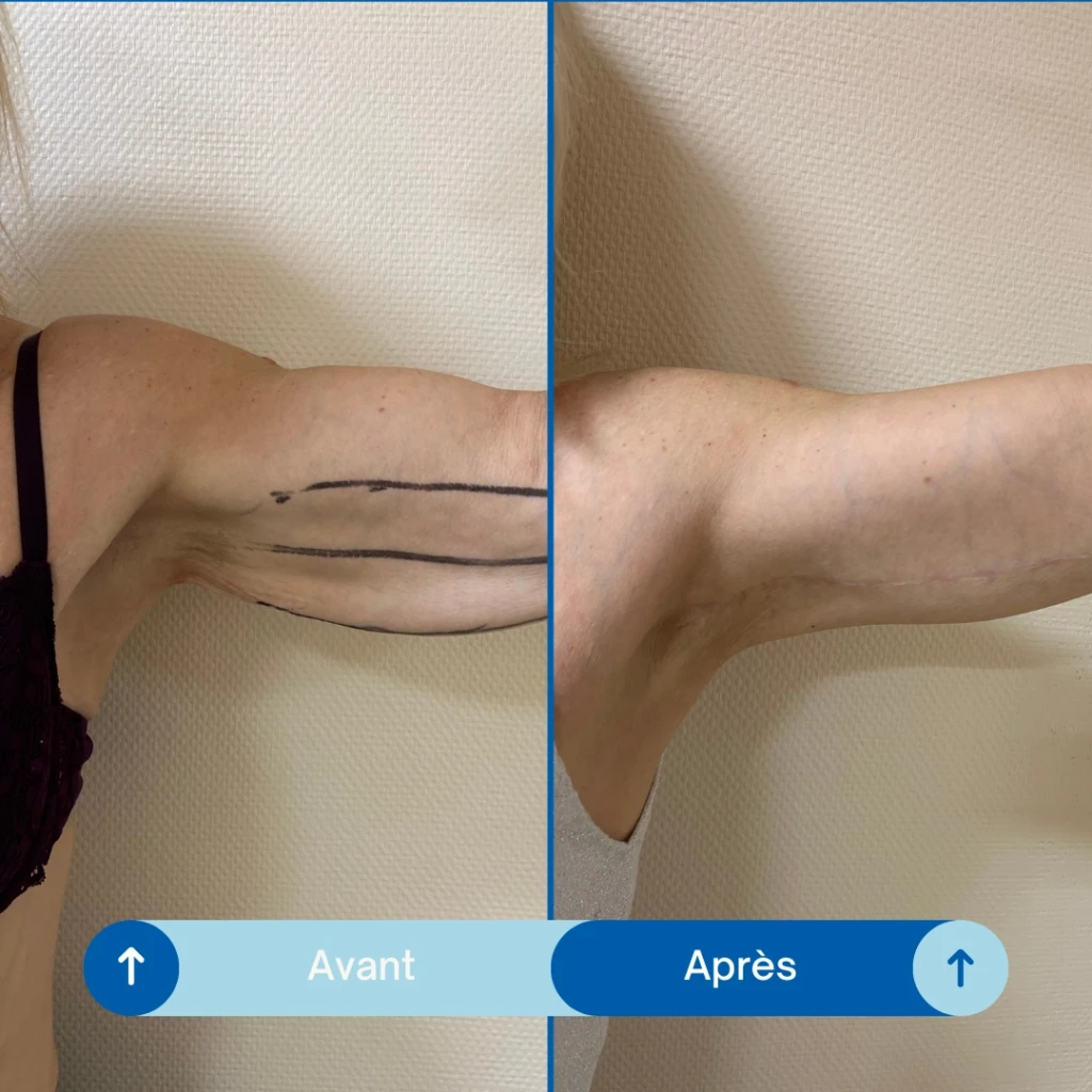 Lipectomie bras