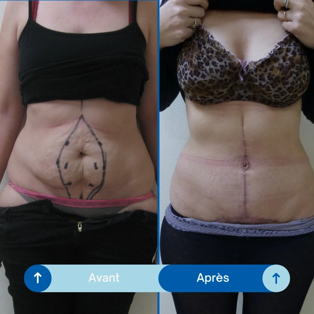 Plastie Abdominale (2)