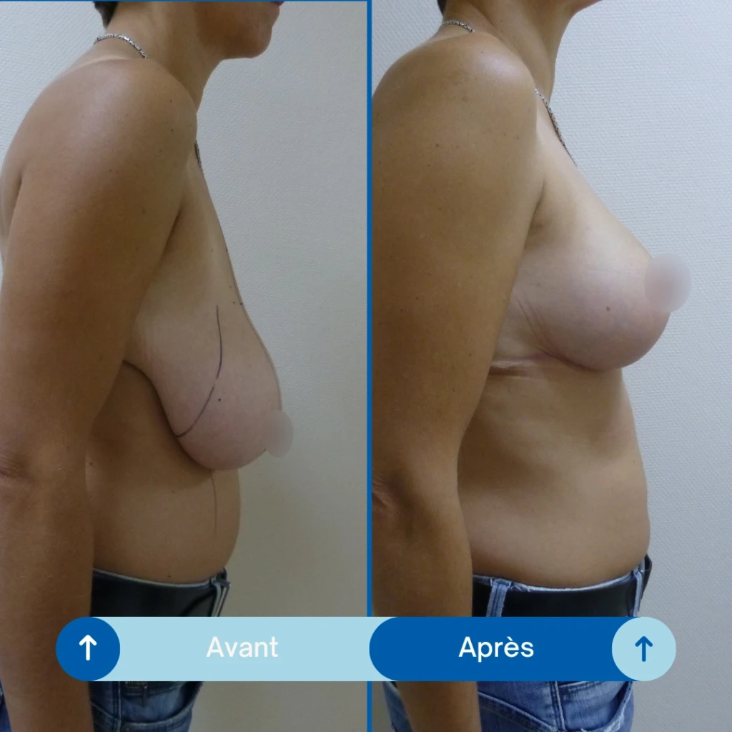 Réduction mammaire
